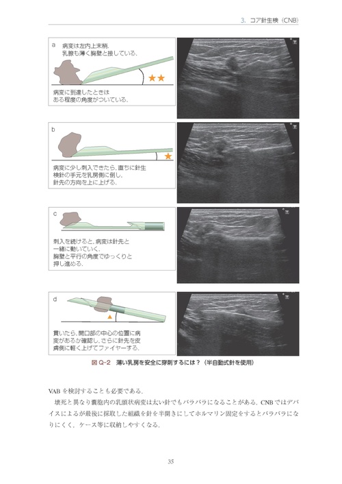 乳房超音波ガイド下針生検マニュアル［Web動画付き］ 細胞診から吸引式