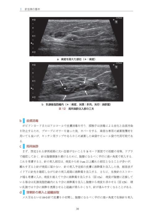 乳房超音波ガイド下針生検マニュアル［Web動画付き］ 細胞診から吸引式