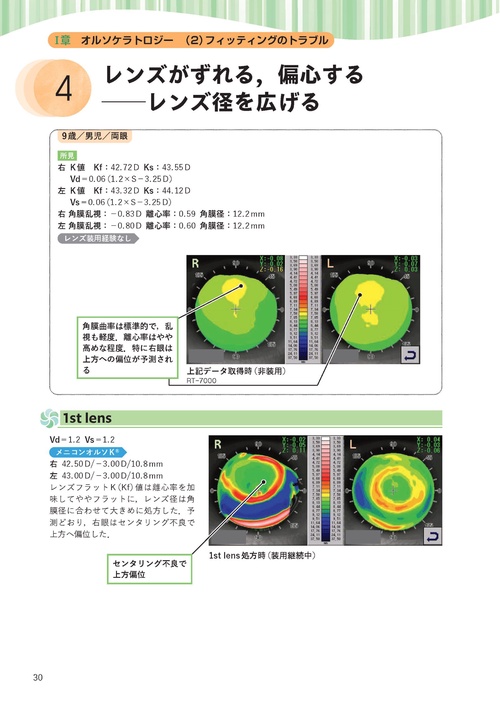 写真でわかる！オルソケラトロジーフィッティング 学童の近視抑制 お