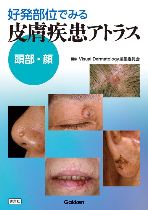 好発部位でみる皮膚疾患アトラス　頭部・顔