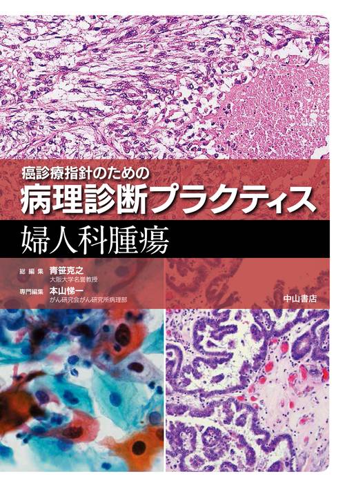 婦人科腫瘍