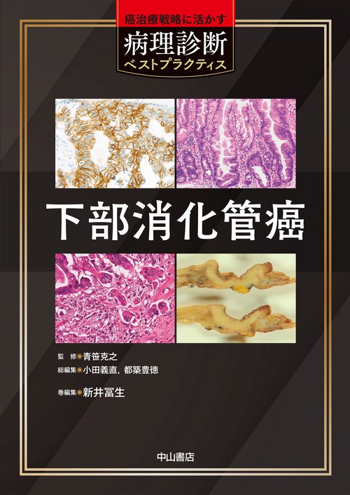 下部消化管癌