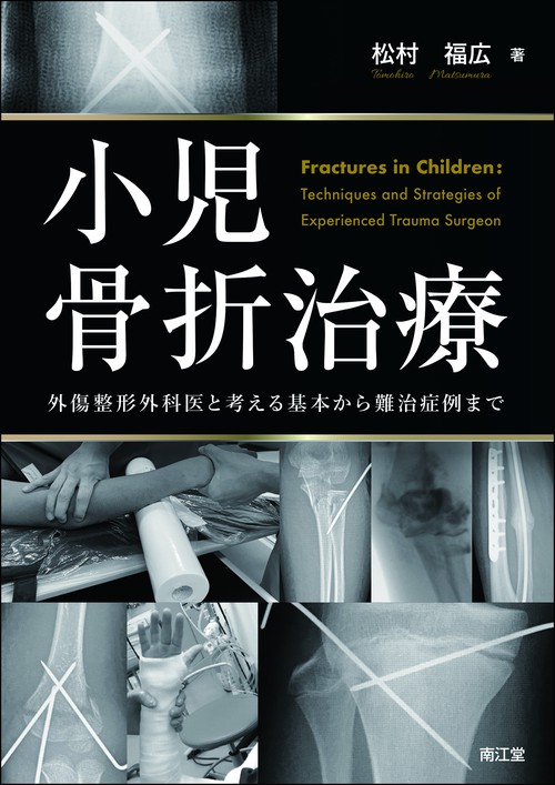 小児骨折治療