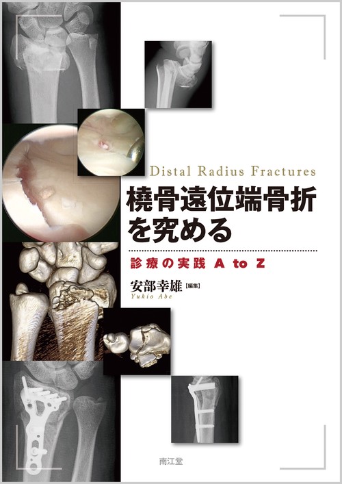橈骨遠位端骨折を究める 診療の実践A to Z