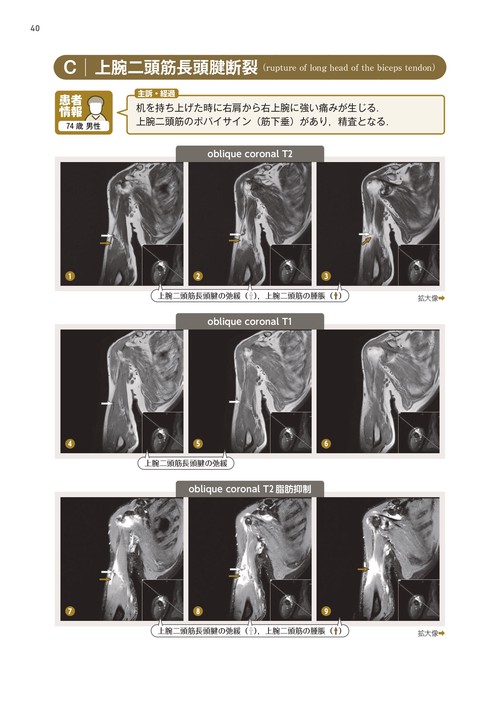 上肢MRI読影の一手