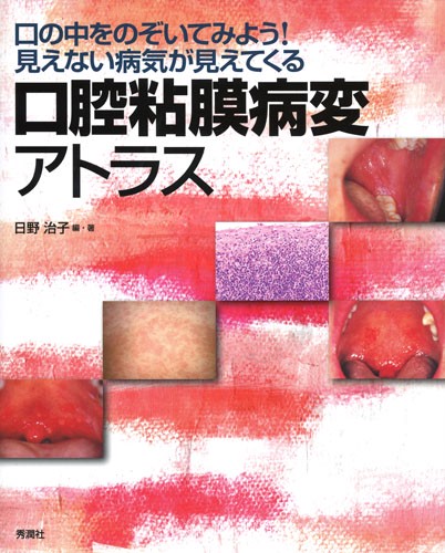 口腔粘膜病変アトラス