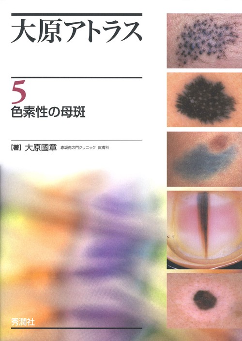 大原アトラス　５　色素性の母斑