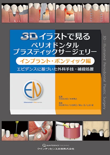 3Dイラストで見るペリオドンタルプラスティックサージェリー インプラント・ポンティック編