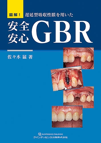 図解!遅延型吸収性膜を用いた安全安心GBR