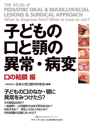 子どもの口と顎の異常・病変 口の粘膜編
