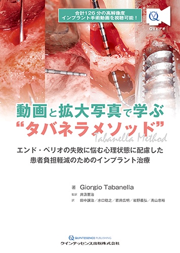 動画と拡大写真で学ぶ"タバネラメソッド" エンド・ペリオの失敗に悩む心理状態に配慮した患者負担軽減のためのインプラント治療