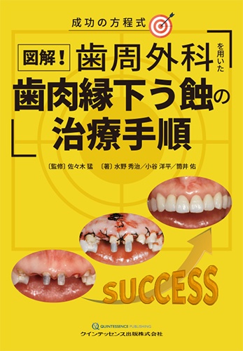 図解!歯周外科を用いた歯肉縁下う蝕の治療手順 成功の方程式