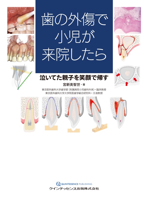 歯の外傷で小児が来院したら
