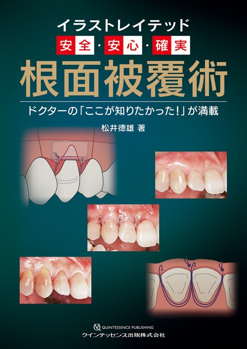 イラストレイテッド　安全・安心・確実　根面被覆術