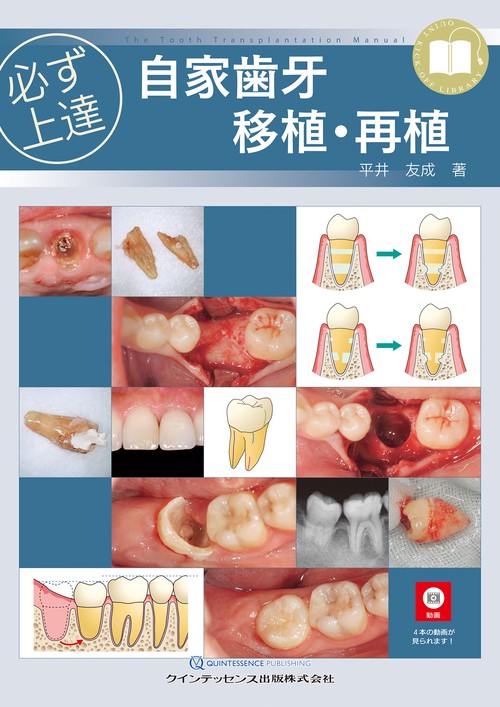必ず上達　自家歯牙移植・再植