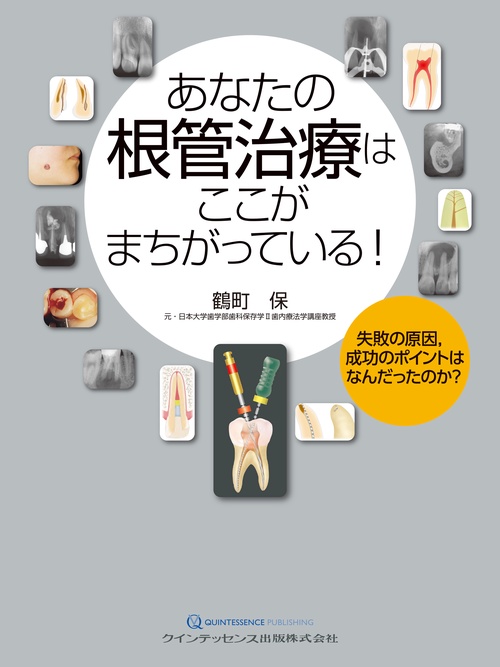 あなたの根管治療はここがまちがっている！
