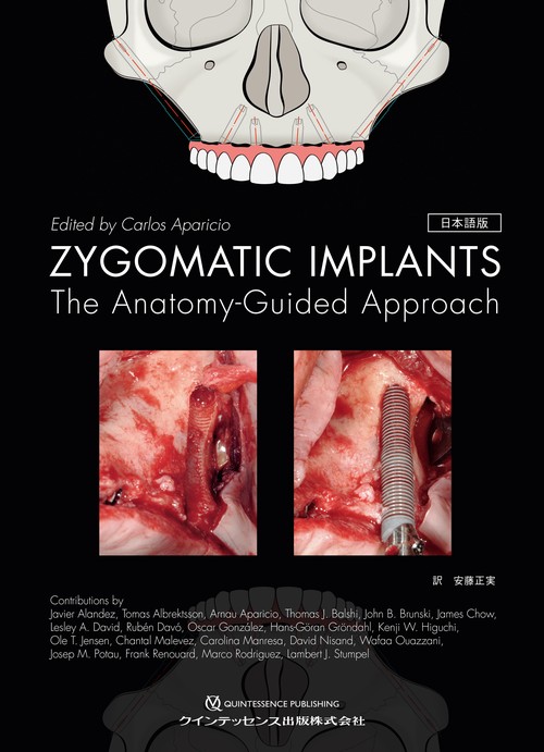 ZYGOMATIC IMPLANTS　日本語版
