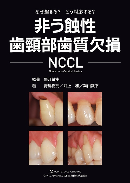 非う蝕性歯頸部歯質欠損 NCCL