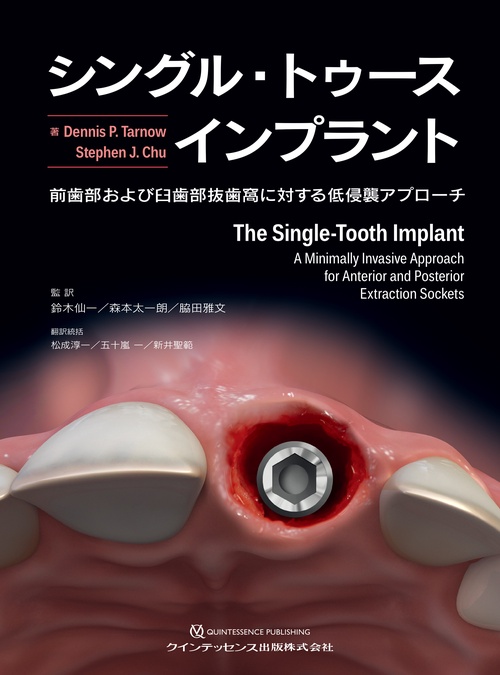 シングル・トゥースインプラント