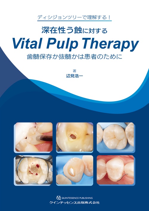 深在性う蝕に対するVital Pulp Therapy