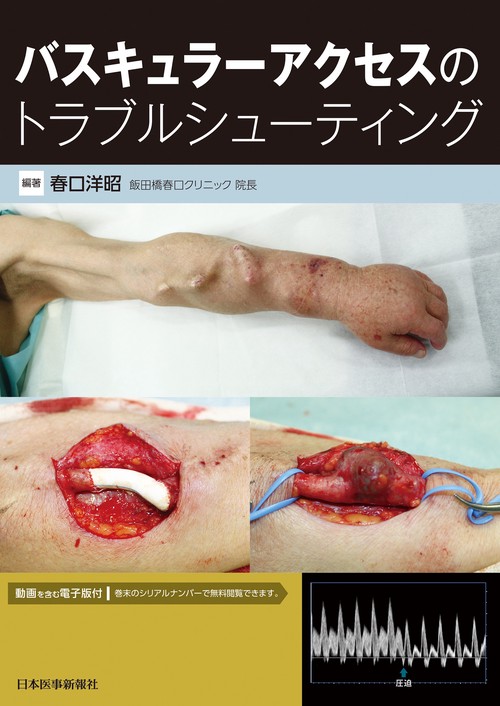バスキュラーアクセスのトラブルシューティング【電子版付】