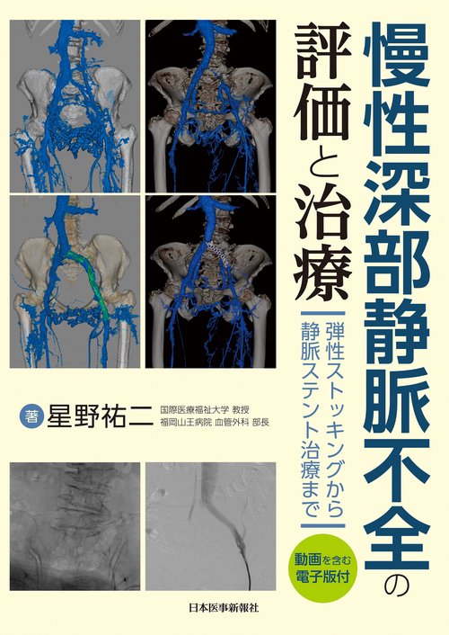 慢性深部静脈不全の評価と治療