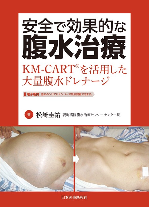 安全で効果的な腹水治療　KM-CART®を活用した大量腹水ドレナージ
