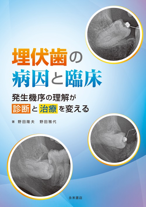 埋伏歯の病因と臨床 —発生機序の理解が診断と治療を変える—