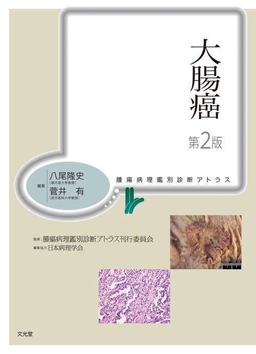 大腸癌