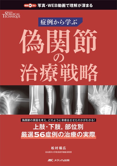 偽関節の治療戦略