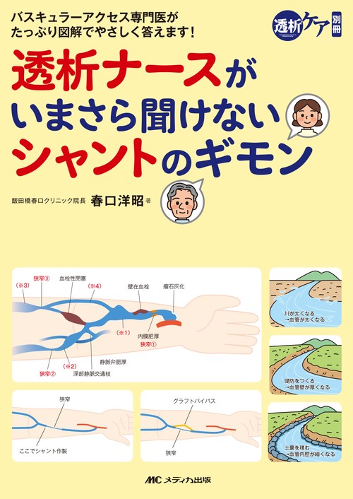 透析ナースがいまさら聞けないシャントのギモン