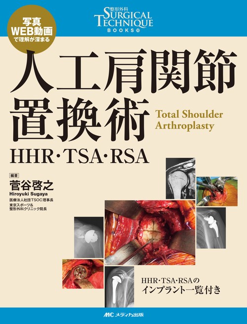 人工肩関節置換術