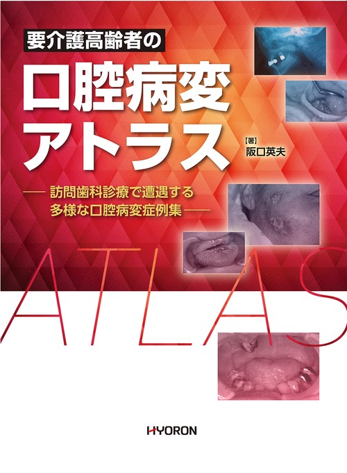 要介護高齢者の 口腔病変アトラス